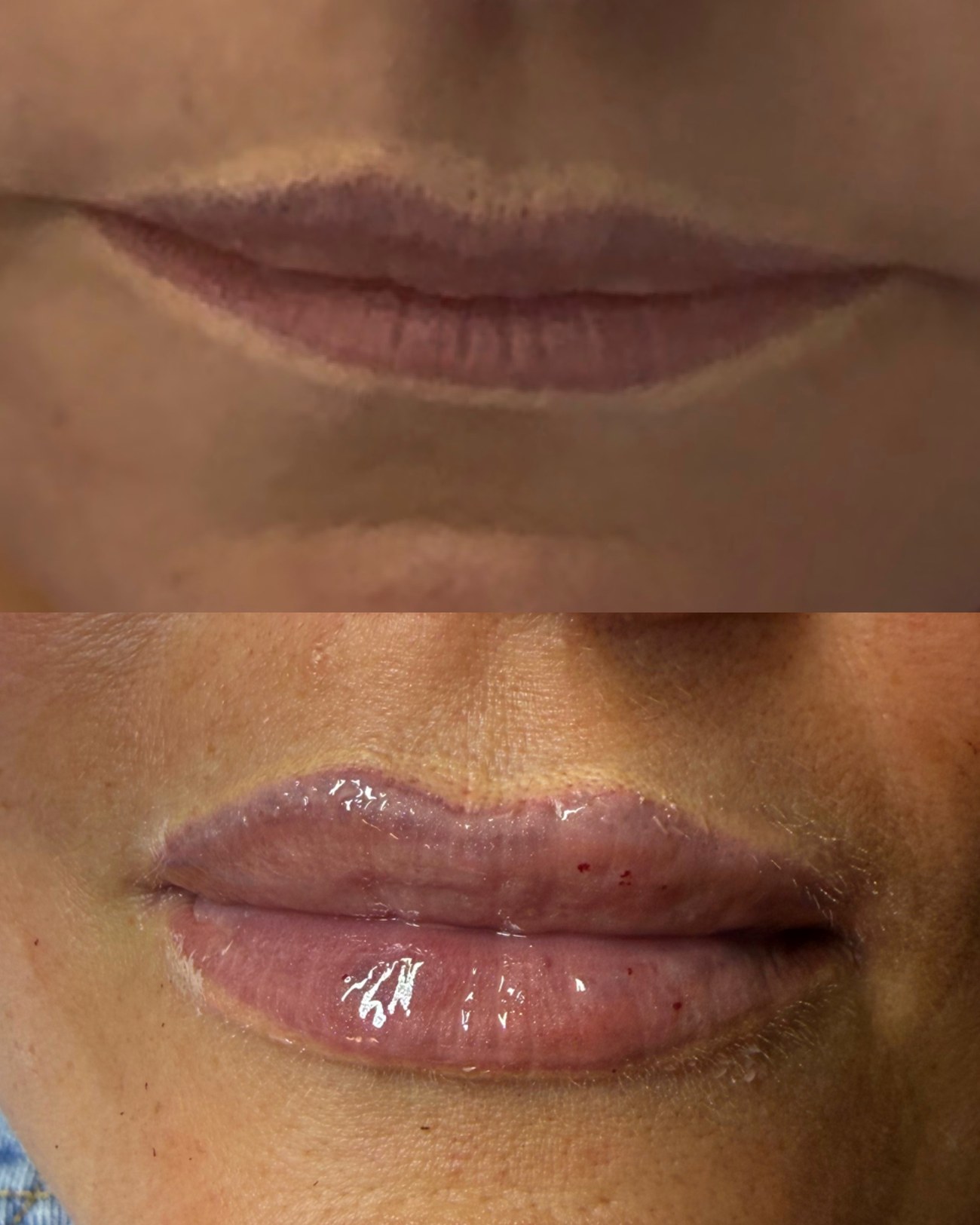 Before and after lip filler by Chelsea Walker, a natural, subtle enhancement