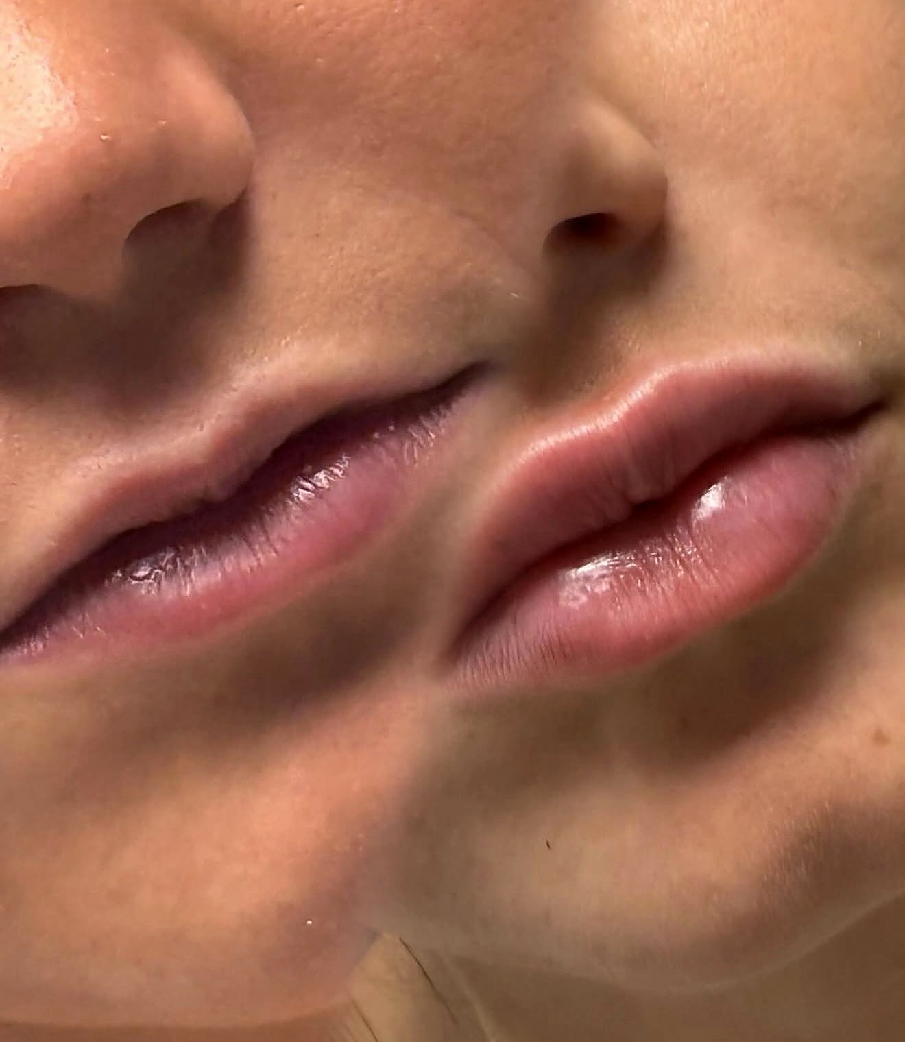 Lip filler result by Chelsea Walker, a soft, glossy finish
